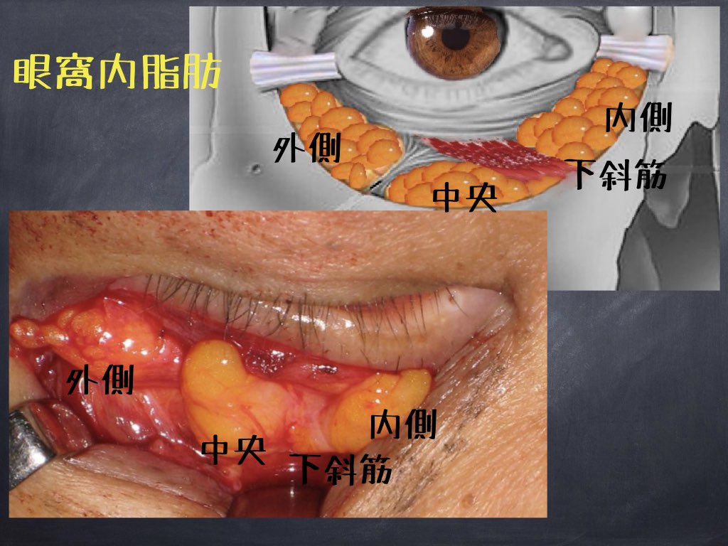 眼窩内脂肪
解剖